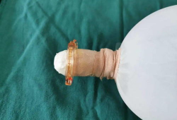 包皮手术 视频,专业视频带你了解手术细节